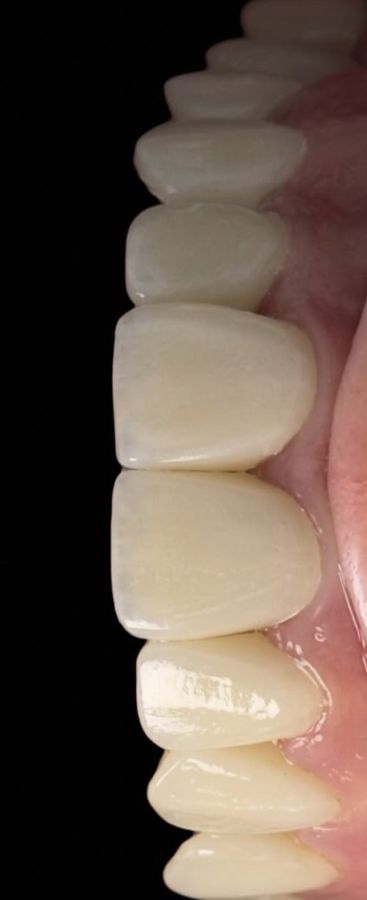 Dents antérieures après restauration