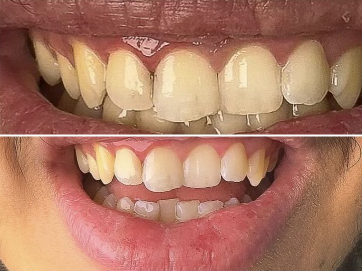 Sourire avant et après restauration des dents de devant