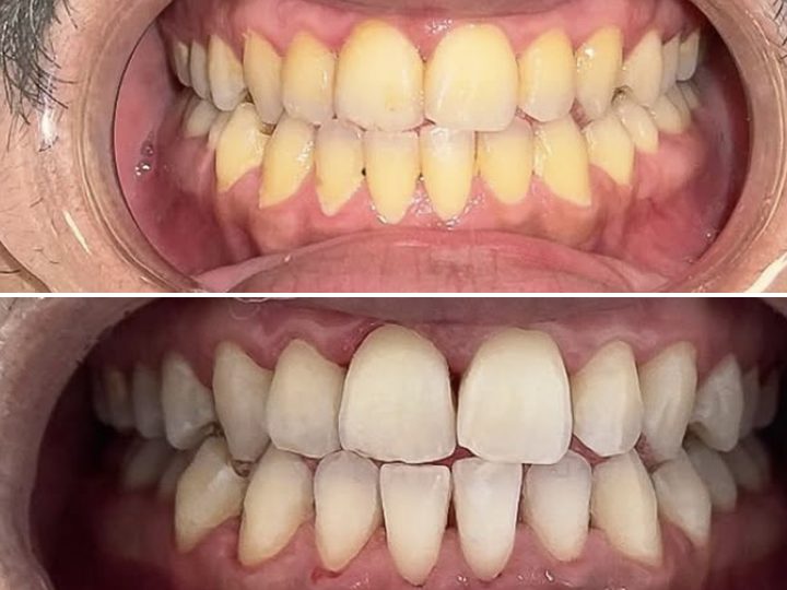 Dents avant et après éclaircissement