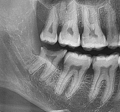 Radiographie dentaire