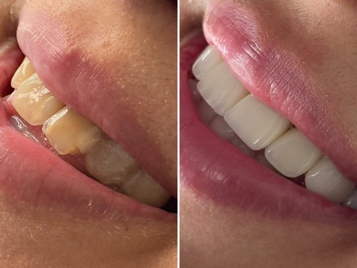 Sourire avant et après facettes, cas du cabinet AFD Dental Care
